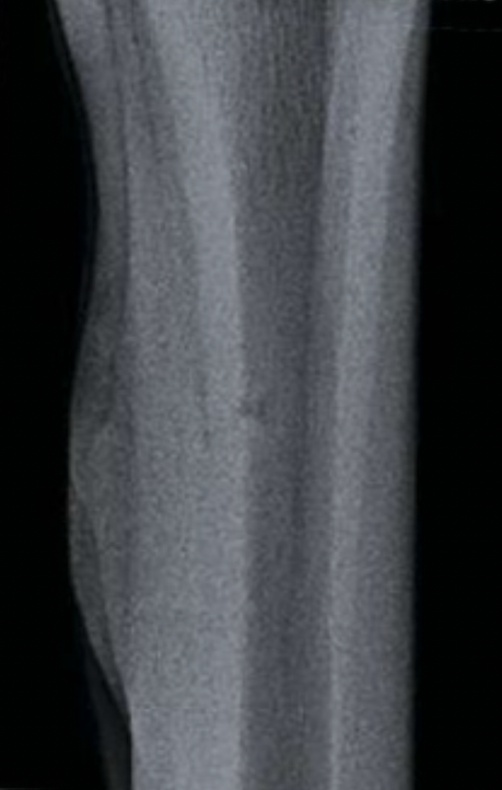 Pictured is an X-ray showing a splint on the inside of a horse's leg